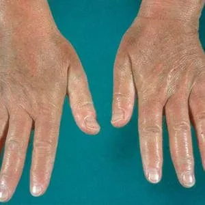  Contact Dermatitis